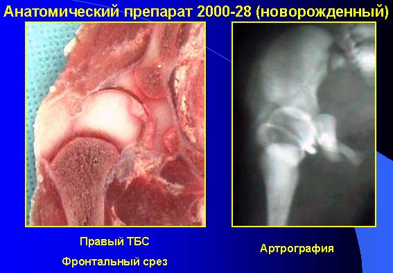 ПОЗДНЕЕ ОБРАЗОВАНИЕ ЯДЕР ОКОСТЕНЕНИЯ ТАЗОБЕДРЕННЫХ СУСТАВОВ