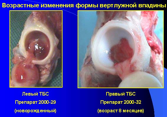 УЗИ тазобедренных суставов новорожденному