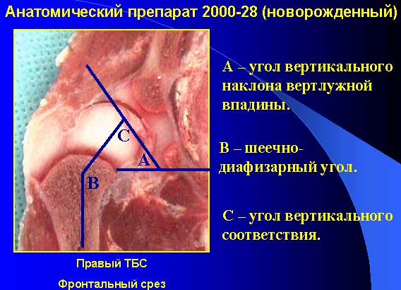 Угол наклона крыши вертлужной впадины в 3 года