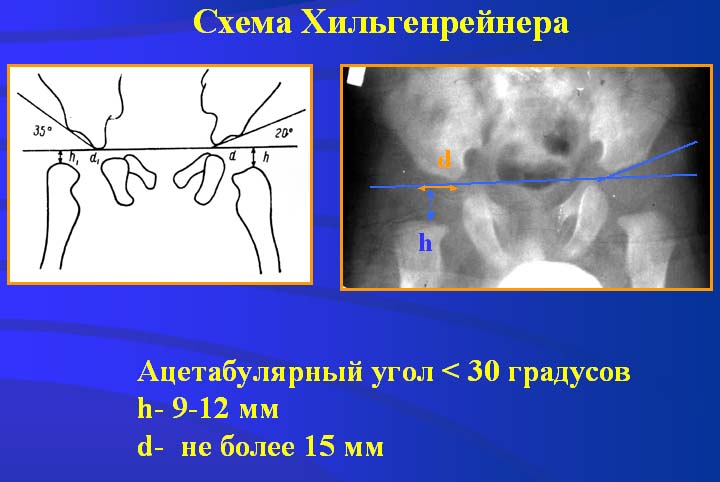 Рентгенодиагностика врожденных вывихов бедра