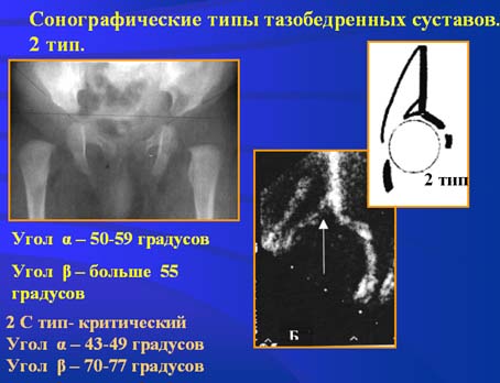 Узи тазобедренного сустава у детей. УЗИ тазобедренных суставов углы измерения. УЗИ тазобедренных суставов при дисплазии. Угол Альфа УЗИ тазобедренных суставов. Угол Альфа тазобедренного сустава норма.